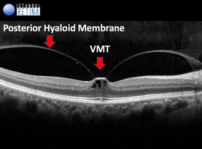 Vitreomacular Traction | OCT Club