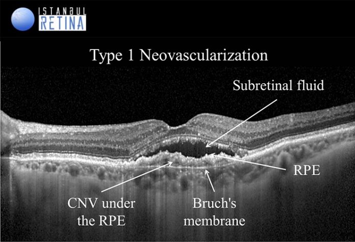 Age-related Macular Degeneration | OCT Club