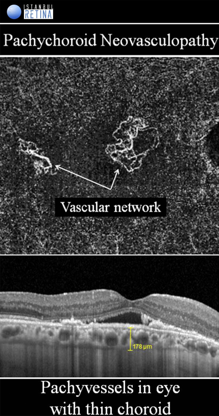 Normal Pachy Pachychoroid Spectrum Diseases | OCT Club