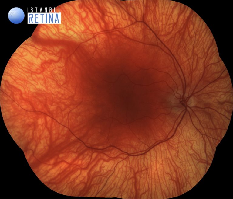 normal retina vs albino retina