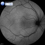 normal retina vs albino retina