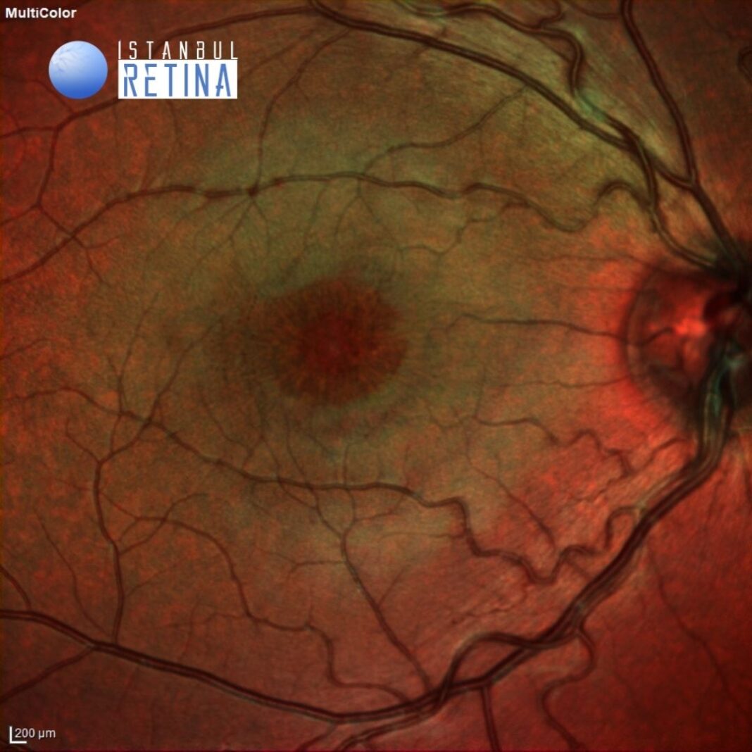 41. Juvenile Retinoschisis OCT Club