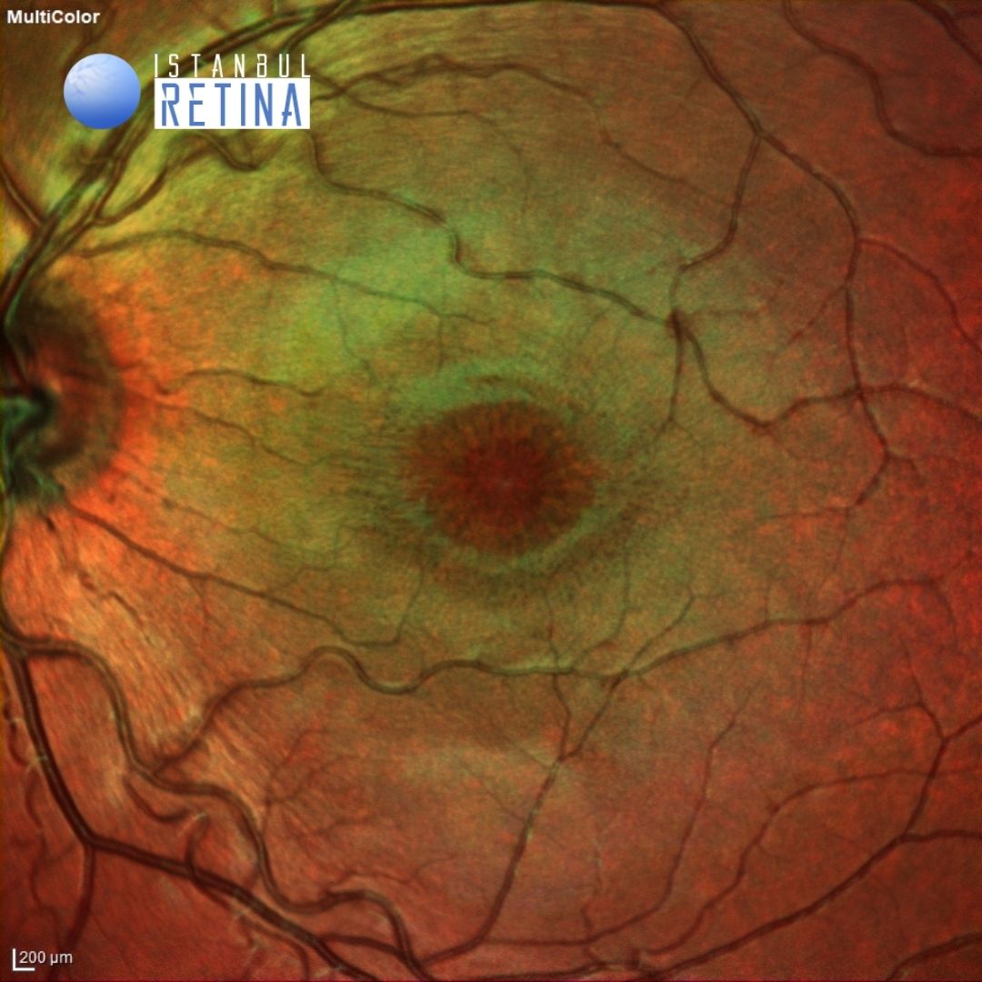 41. Juvenile Retinoschisis OCT Club