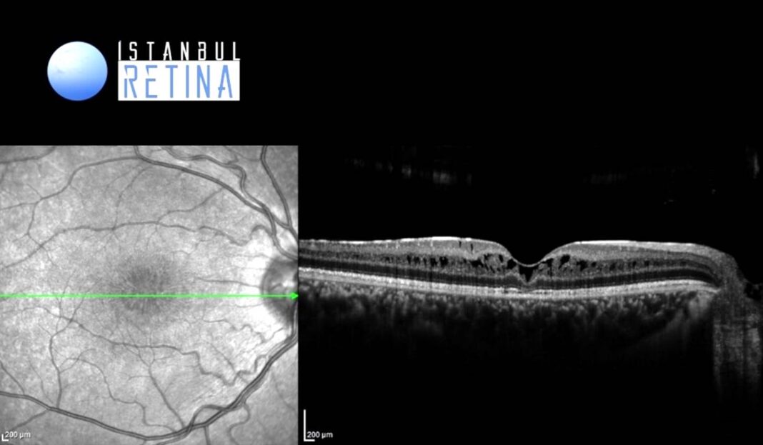 41. Juvenile Retinoschisis OCT Club