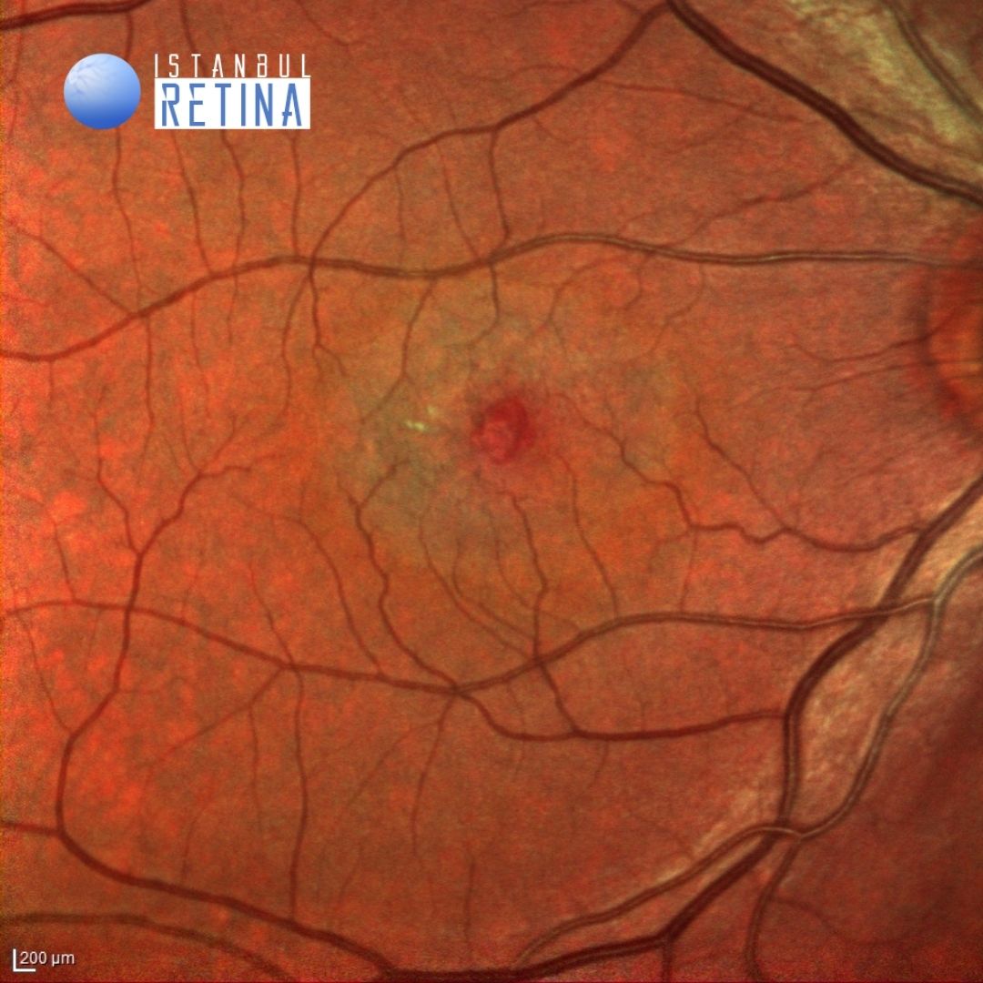 43 Macular Telangiectasia Type 2 Oct Club 