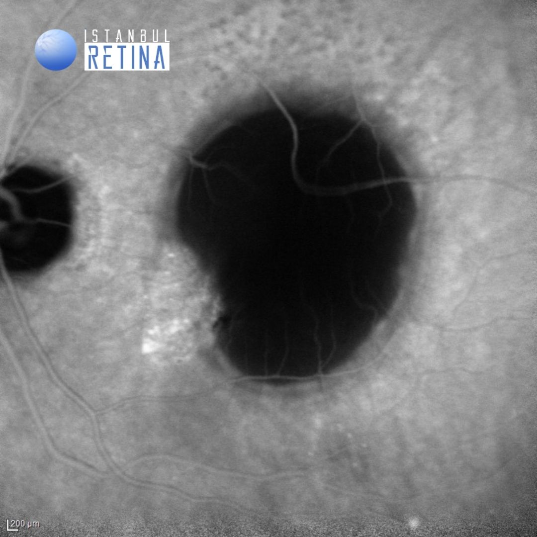 49 Vascularized Serous Pigment Epithelial Detachment In Age Related