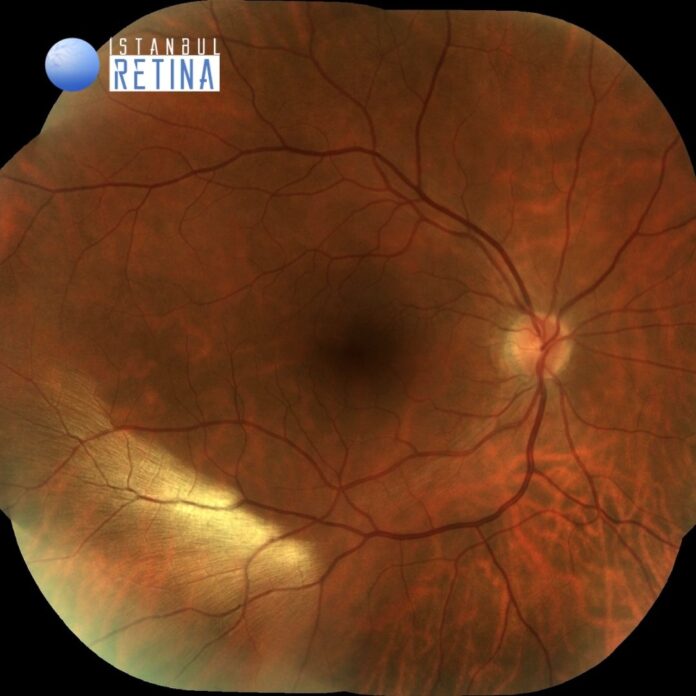 56. Myelinated Retinal Nerve Fiber Layer OCT Club