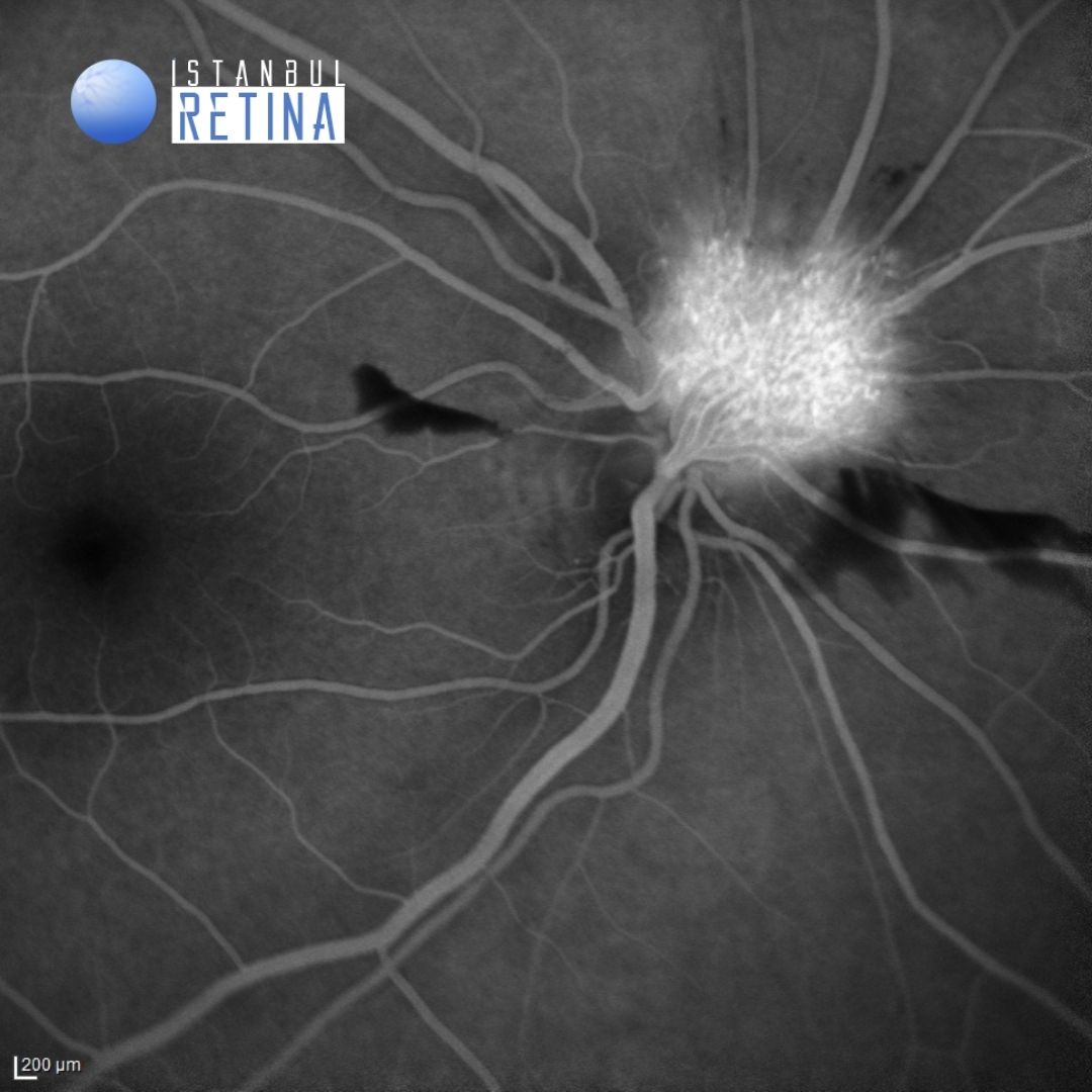 57. Exophytic Juxtapapillary Retinal Capillary Hemangioma OCT Club